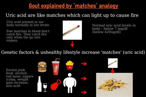Gout causes, attack and treatment explained – by simple ‘matchstick’ analogy